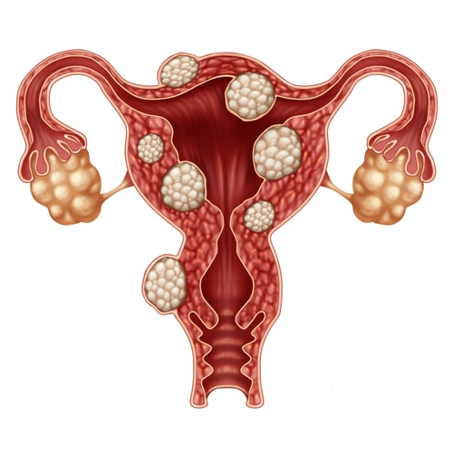 Endometriosis min